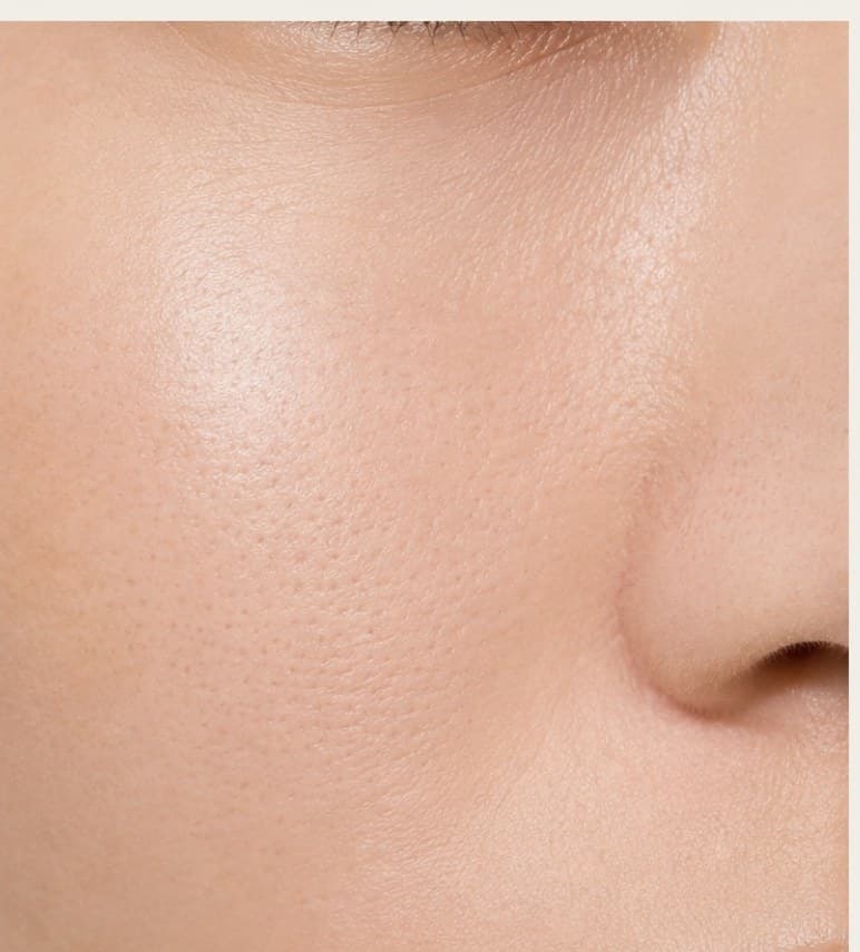 Joue : grain de peau et pores avant / après 4 semaines avec le sérum naeul